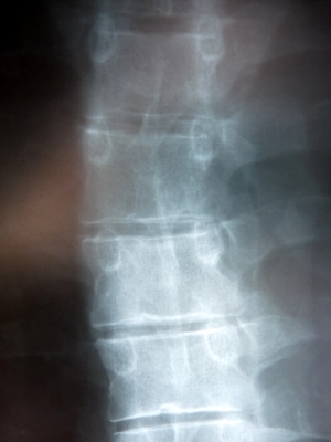 verbogene Wirbelsäule (Röntgenbild)