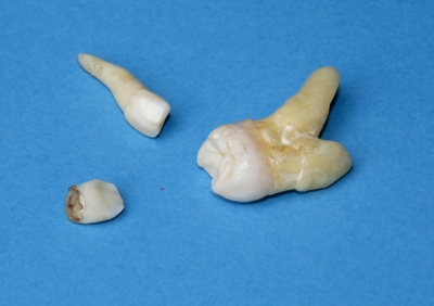 kleine und große Zähne