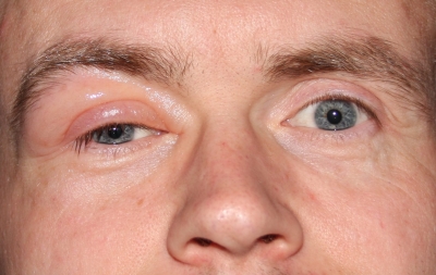 Allergische Reaktion am Augenlid