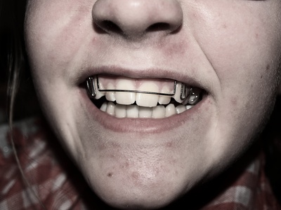 Zahnspange im Mund