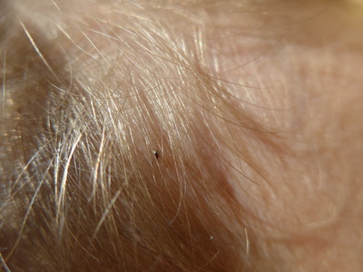 Vorsicht vor Zecken - Zecke im Haar