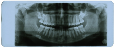 Zahnpanorama, Röntgenaufnahme