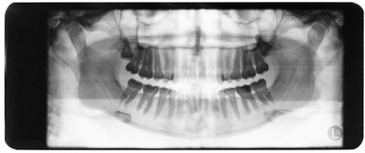 Zahnpanorama, Röntgenaufnahme